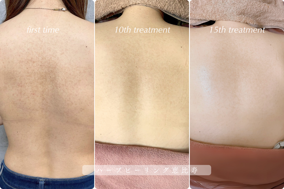 ↑ 毛孔性苔癬にお悩みの方はこちら